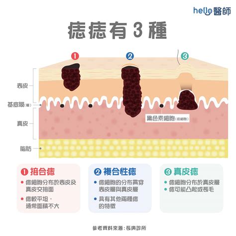 臉部有痣|痣形成的原因？痣長毛、痣變多變大是痣病變？5招判別